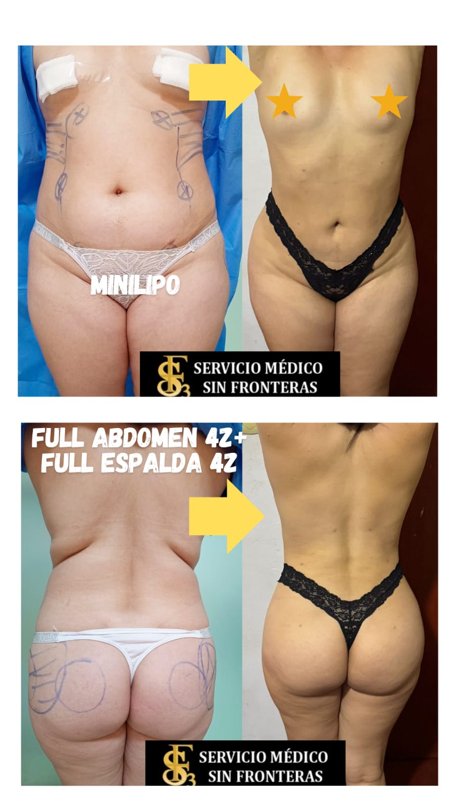 Resultado Lipo 360 3